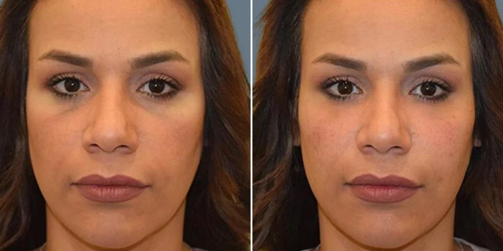 face Volume Enhancement Treatments female pre2024 006 before and after before and after