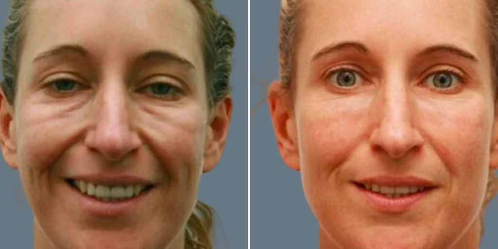face Volume Enhancement Treatments female pre2024 007 before and after before and after