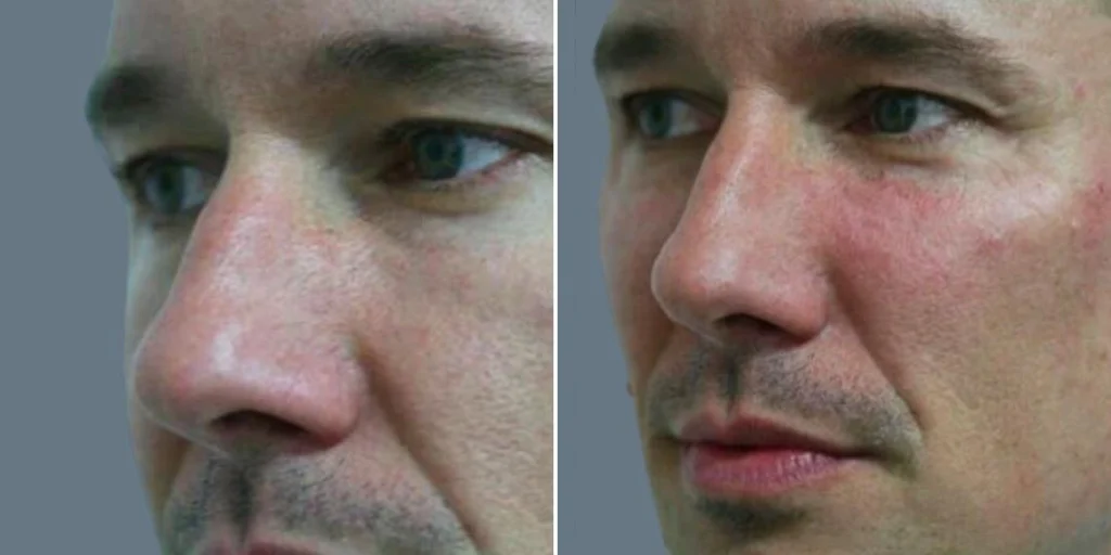 face Volume Enhancement Treatments male pre2024 004 before and after before and after
