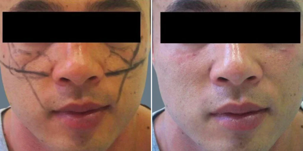 face Volume Enhancement Treatments male pre2024 010  before and after before and after