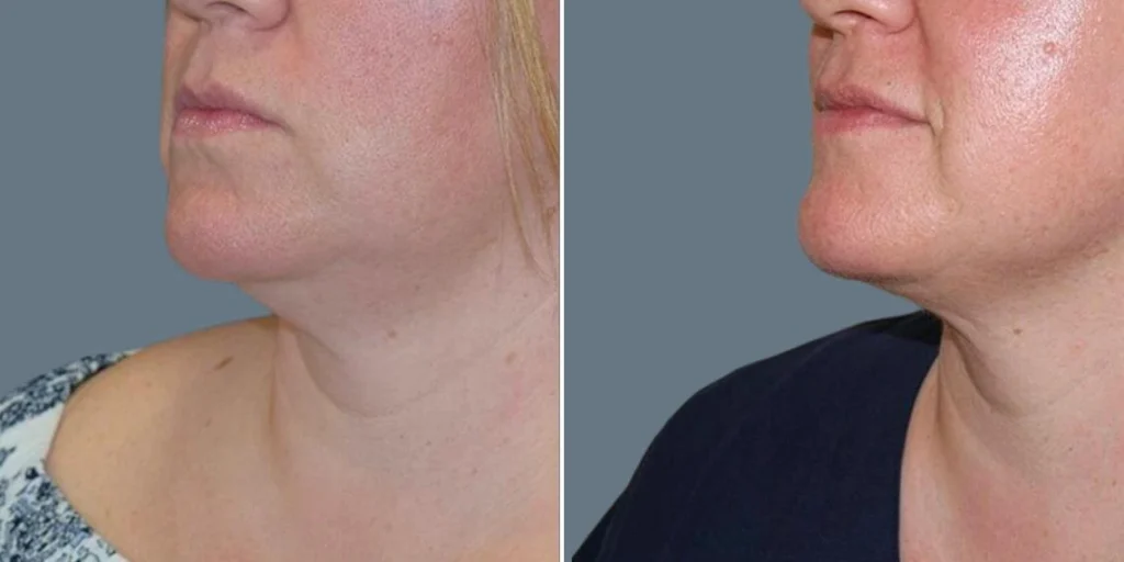 face fat dissolving injections female pre2024 003 before and after before and after