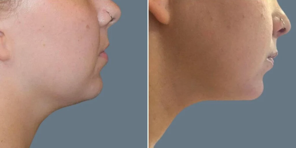face fat dissolving injections female pre2024 004 before and after before and after