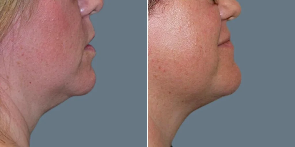 face fat dissolving injections female pre2024 005 before and after before and after