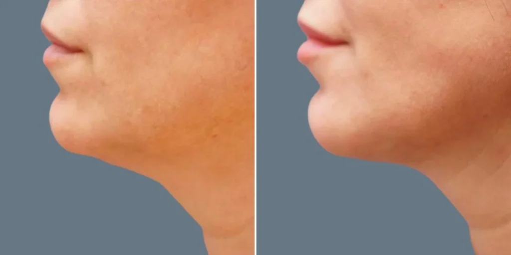 face fat dissolving injections female pre2024 006 before and after before and after