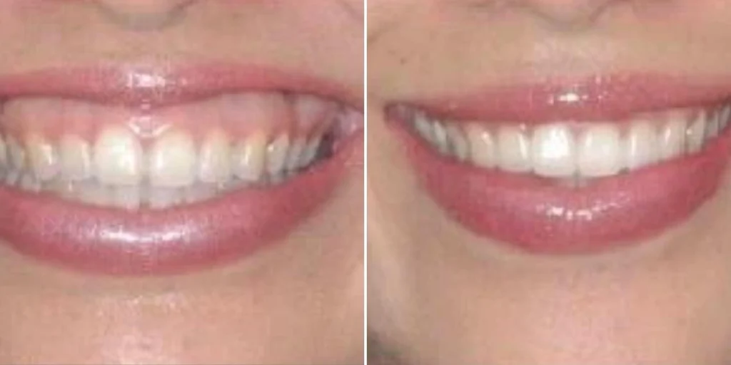 Excessive gingival display before and after at Cosmos Clinic