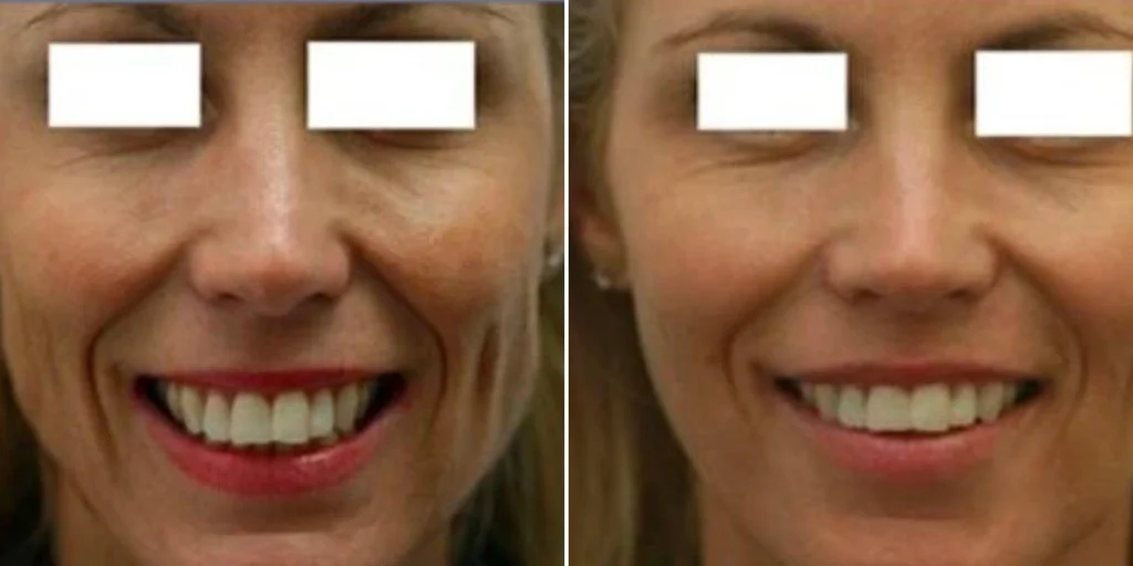 face jaw line contouring female pre2024 001  before and after before and after