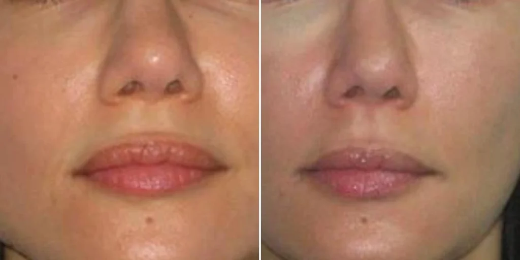 face jaw line contouring female pre2024 002 before and after before and after