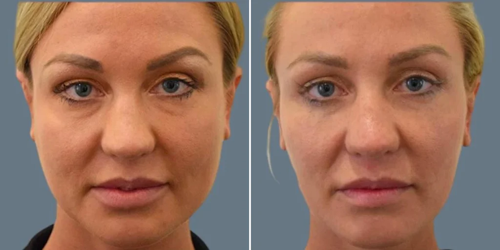 face jaw line contouring female pre2024 003 before and after before and after