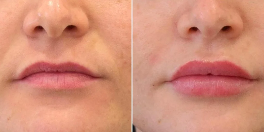 face lip enhancement female pre2024 001 before and after before and after