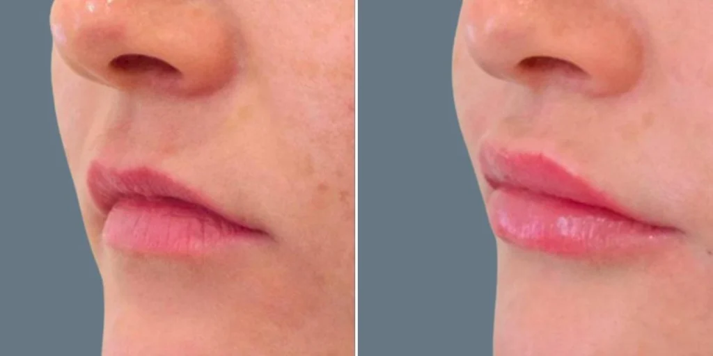 face lip enhancement female pre2024 004 before and after before and after