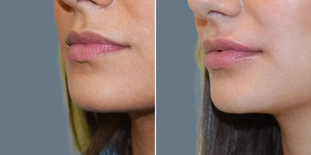 face lip enhancement female pre2024 006 before and after before and after