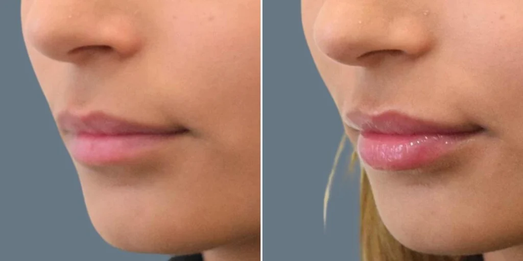 face lip enhancement female pre2024 012 before and after before and after