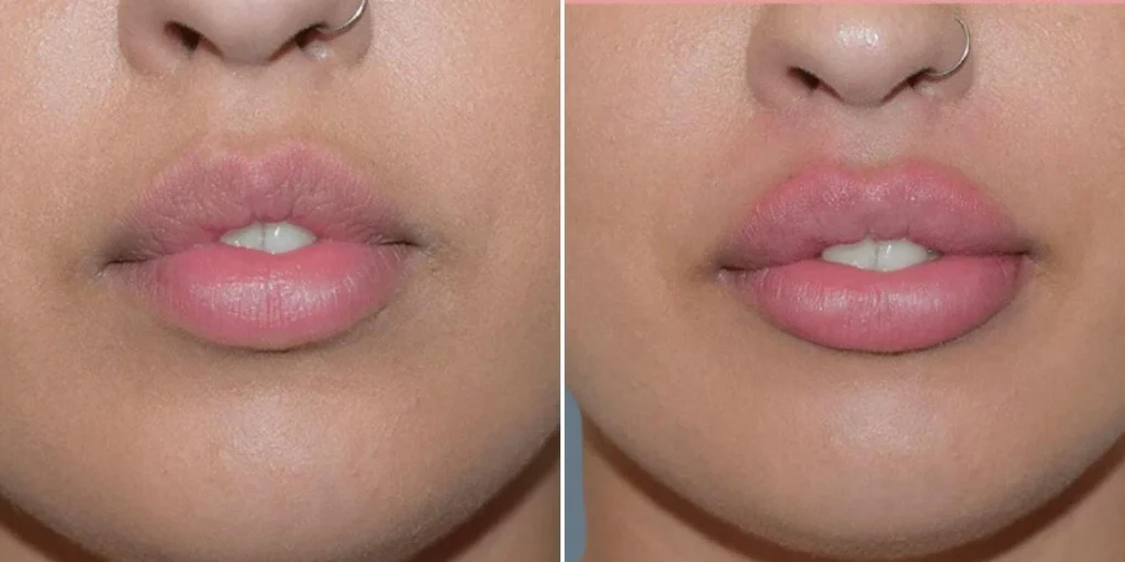 face lip enhancement female pre2024 013 before and after before and after
