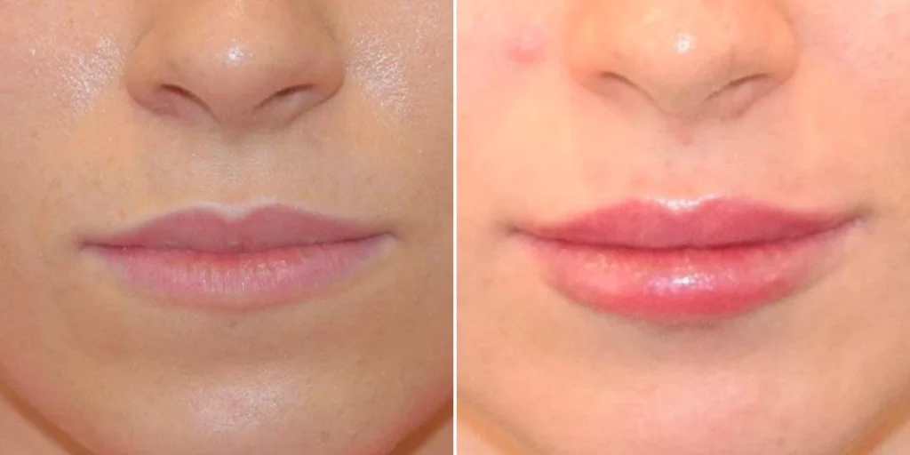 face lip enhancement female pre2024 014 before and after before and after