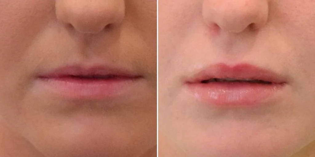 Before and after dermal fillers of the face.