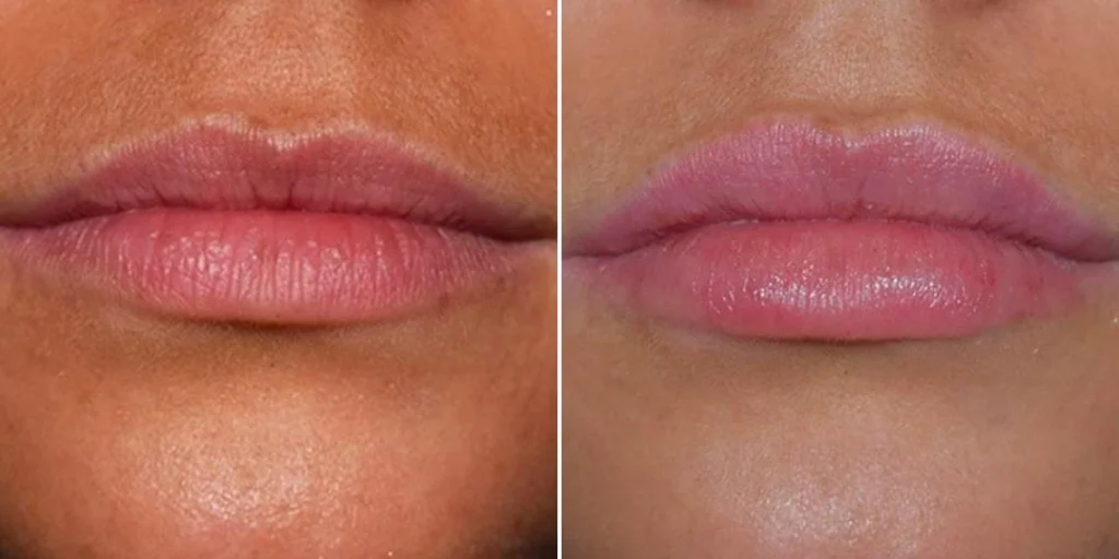 face lip enhancement female pre2024 020 before and after before and after