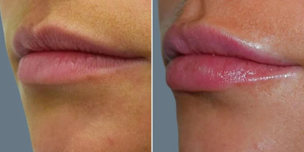 face lip enhancement female pre2024 021 before and after before and after