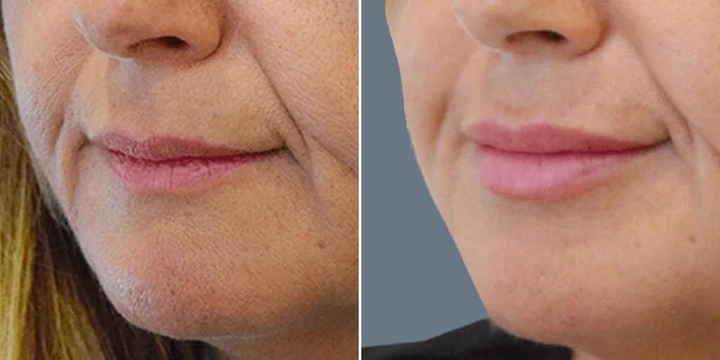 face lip enhancement female pre2024 023 before and after before and after