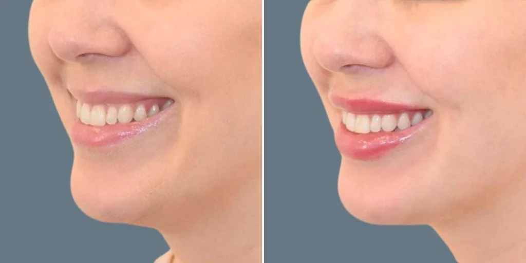 face lip enhancement female pre2024 025 before and after before and after