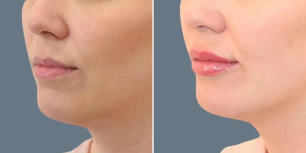 face lip enhancement female pre2024 026 before and after before and after