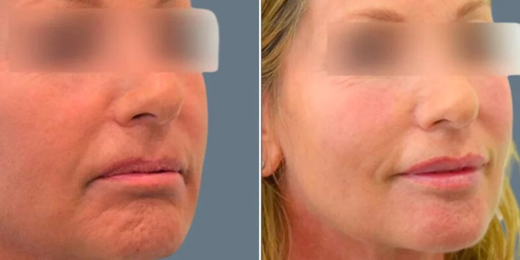 face lip enhancement female pre2024 033 before and after before and after
