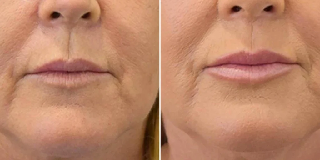 face lip enhancement female pre2024 034 before and after before and after