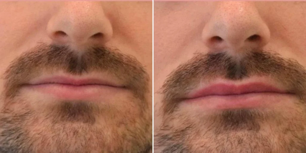 face lip enhancement male pre2024 018 before and after before and after