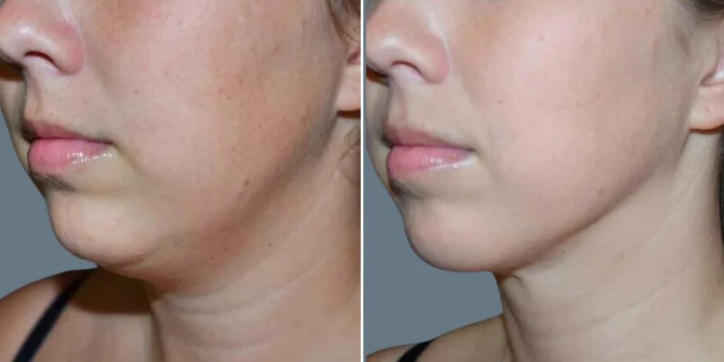 face lower face liposuction female pre2024 001 before and after before and after