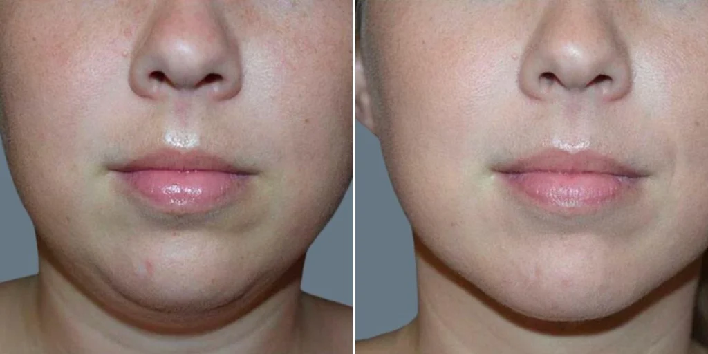 face lower face liposuction female pre2024 002 before and after before and after