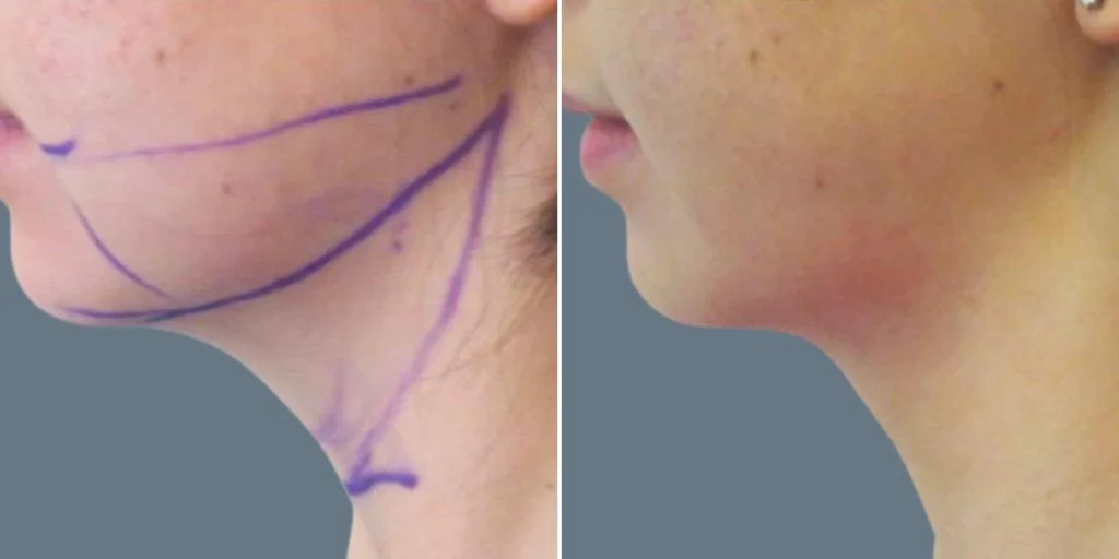 face lower face liposuction female pre2024 004 before and after before and after