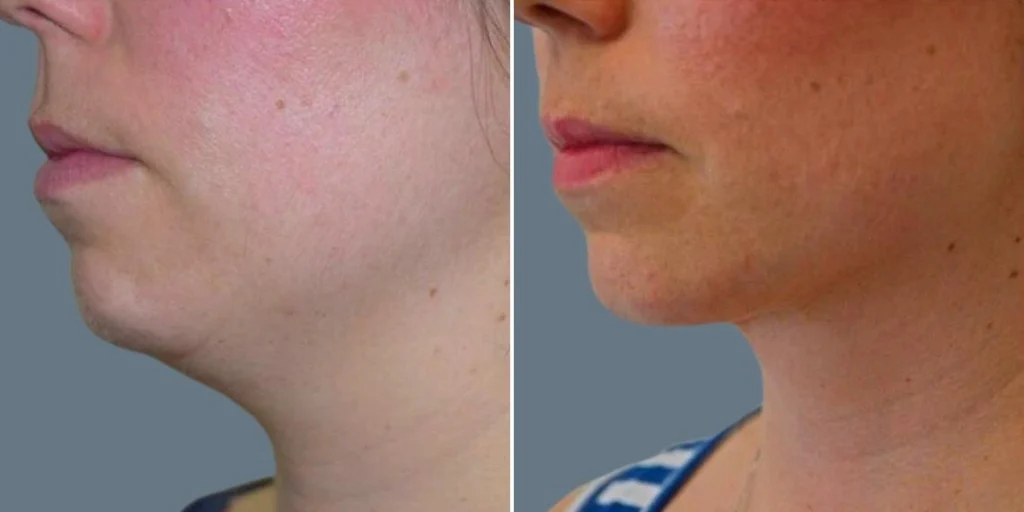 face lower face liposuction female pre2024 007 before and after before and after