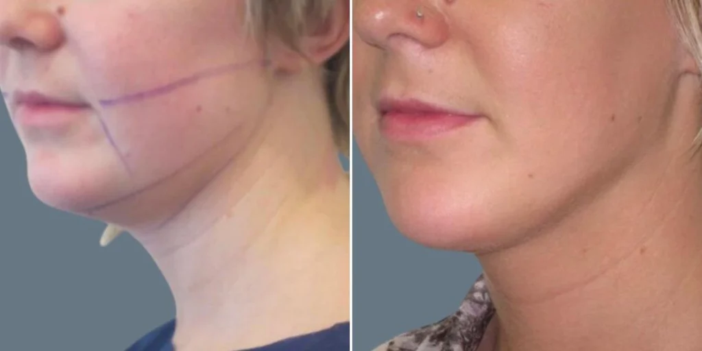 face lower face liposuction female pre2024 009 before and after before and after