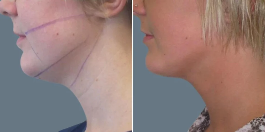 face lower face liposuction female pre2024 011 before and after before and after