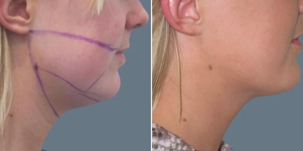 face lower face liposuction female pre2024 012 before and after before and after