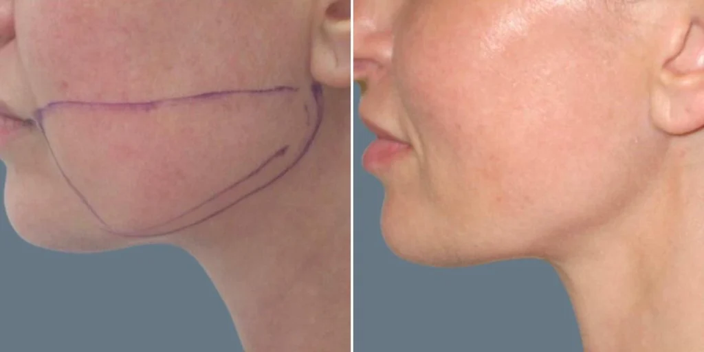 face lower face liposuction female pre2024 015 before and after before and after