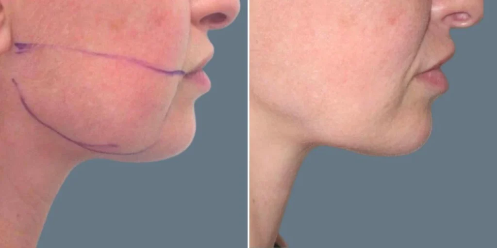 face lower face liposuction female pre2024 016 before and after before and after