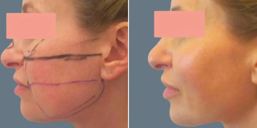 face lower face liposuction female pre2024 018 before and after before and after