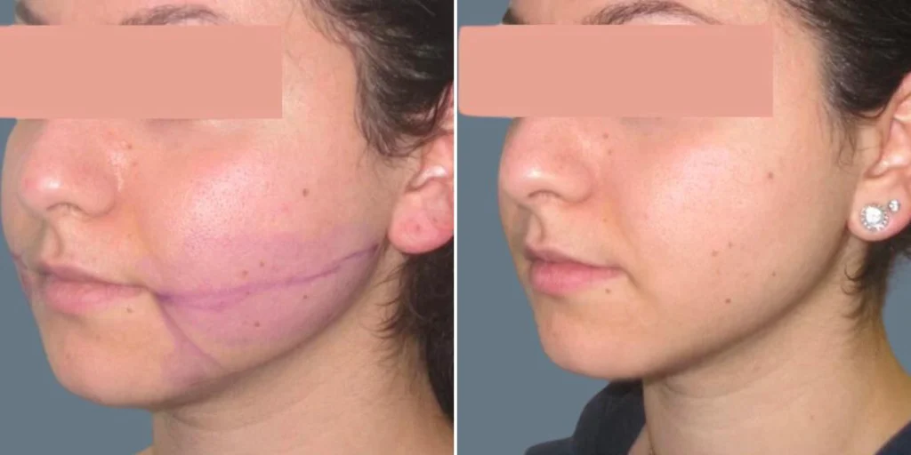 face lower face liposuction female pre2024 020 before and after before and after