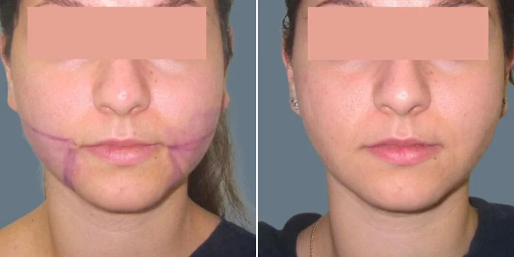 face lower face liposuction female pre2024 021 before and after before and after