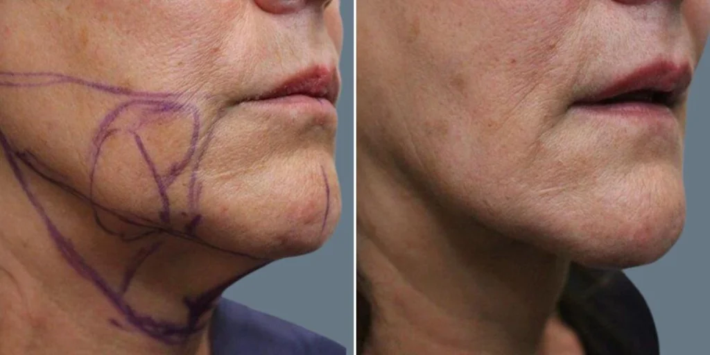 face lower face liposuction female pre2024 022 before and after before and after