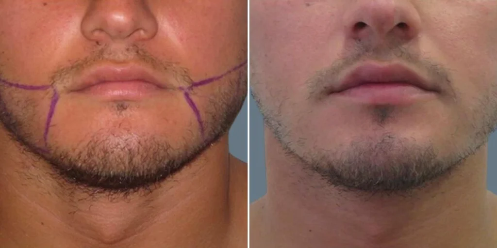 Before and after liposuction of the face.