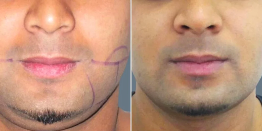 face lower face liposuction male pre2024 006 before and after before and after