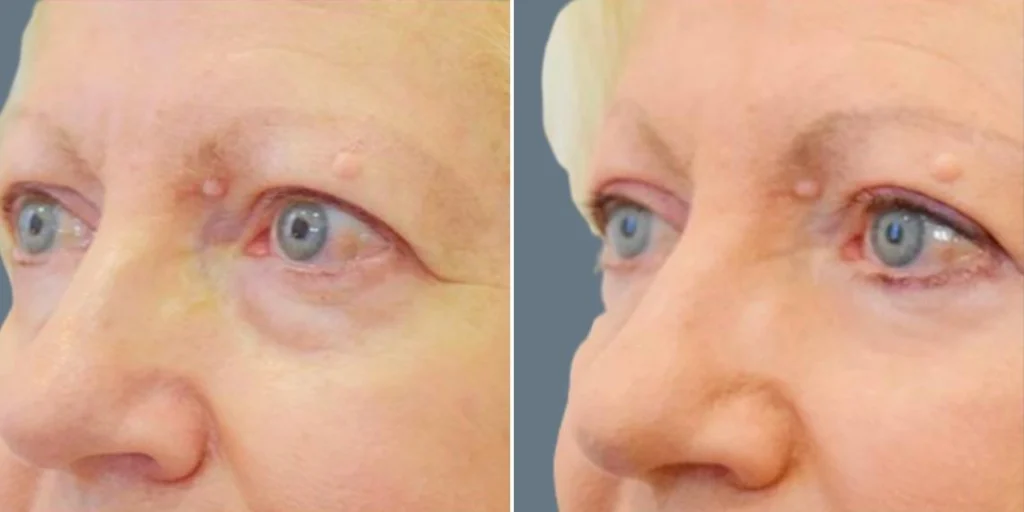 face non surgical eyelid lift female pre2024 001 before and after before and after