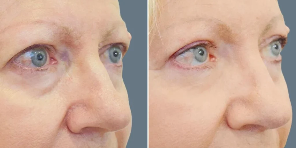 face non surgical eyelid lift female pre2024 002 before and after before and after