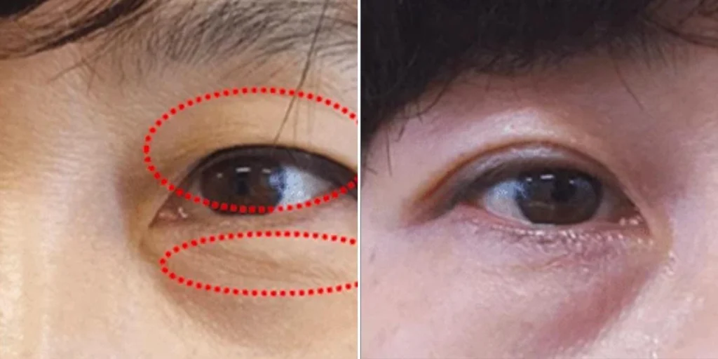 face non surgical eyelid lift female pre2024 006 before and after before and after