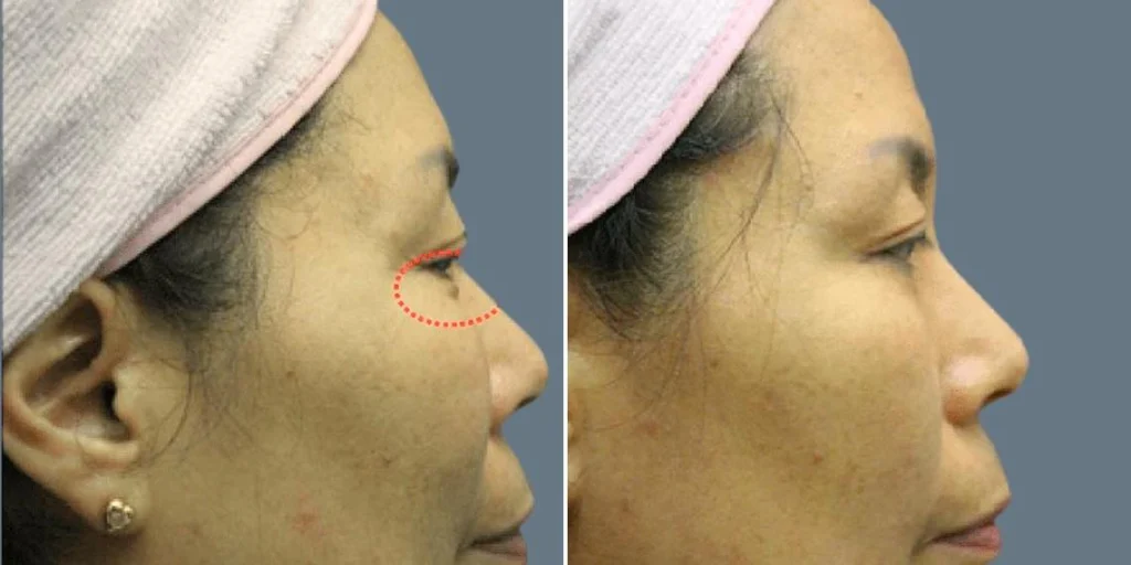 face non surgical eyelid lift female pre2024 007 before and after before and after