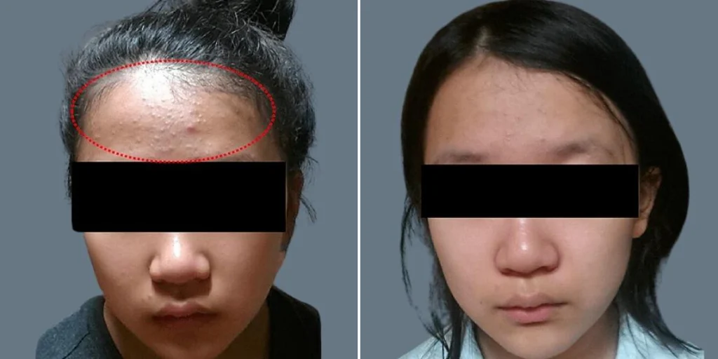 face non surgical eyelid lift female pre2024 010 before and after before and after