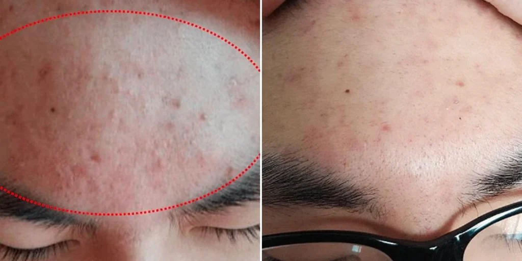 Before and after non surgical eyelid lift of the face.