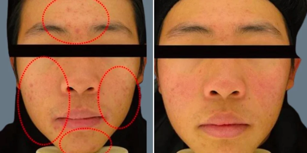face non surgical eyelid lift male pre2024 014 before and after before and after