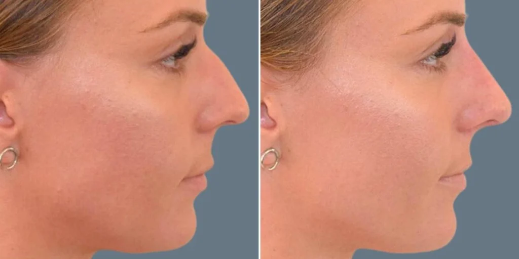 face non surgical nose reshape female pre2024 003 before and after before and after